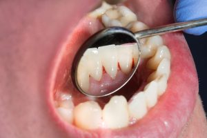 More than 50% of adults in Ireland delayed dental check-ups over the last 12 months